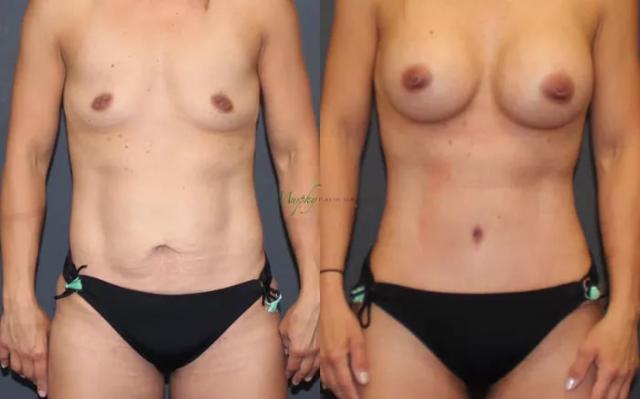 Mommy Makeover result at Murphy Plastic Surgery Group in Englewood, CO