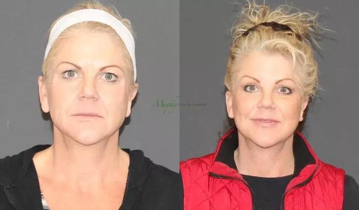 Murphy Plastic Surgery Group eyelid lift result — Englewood, CO