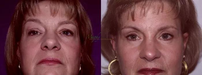 Murphy Plastic Surgery Group eyelid lift result — Englewood, CO