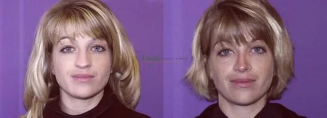 Rhinoplasty result at Murphy Plastic Surgery Group in Englewood, CO
