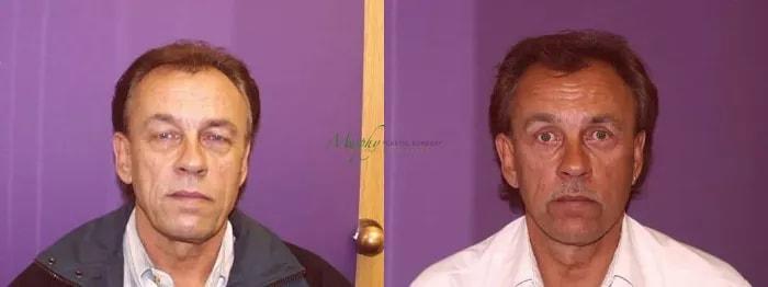 Murphy Plastic Surgery Group eyelid lift result — Englewood, CO