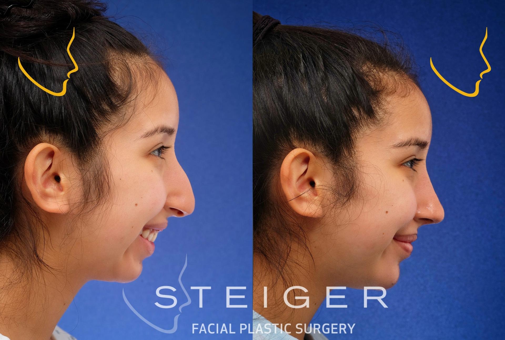 Steiger Facial Plastic Surgery rhinoplasty result — Boca Raton, FL