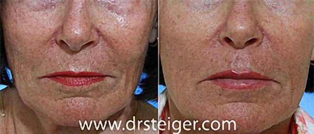 Lip Filler result at Steiger Facial Plastic Surgery in Boca Raton, FL