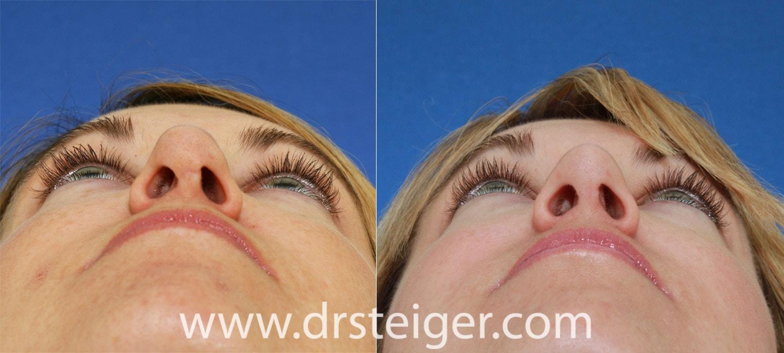 Steiger Facial Plastic Surgery rhinoplasty result — Boca Raton, FL