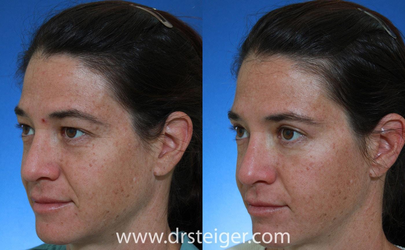 Steiger Facial Plastic Surgery blepharoplasty result — Boca Raton, FL