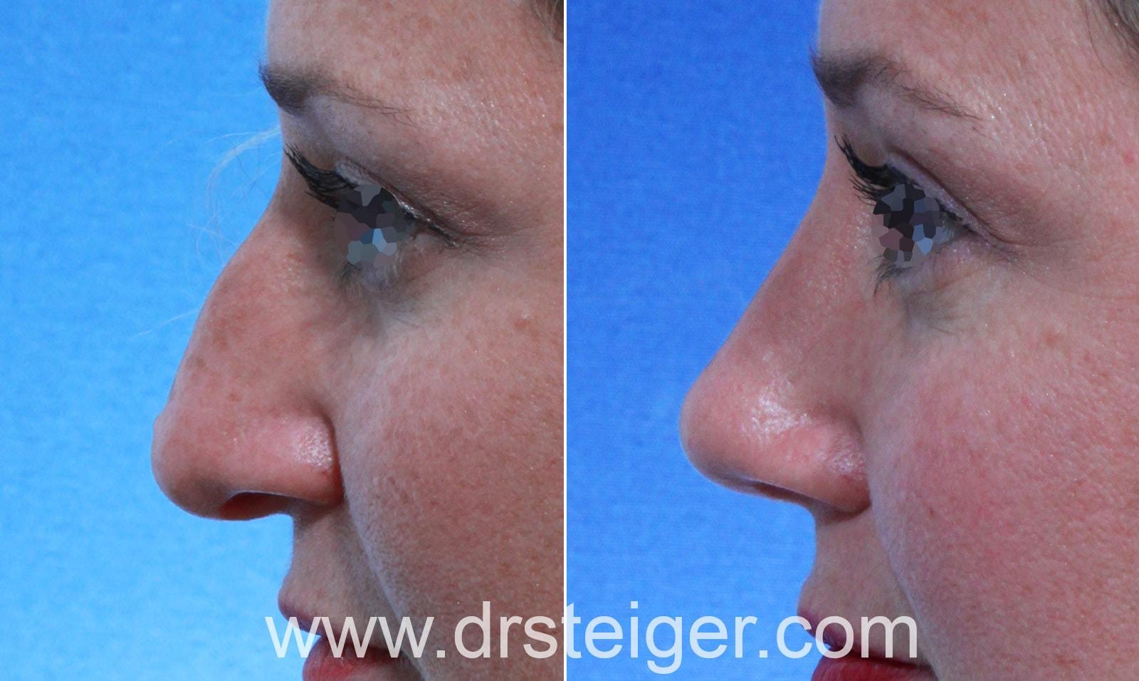 Steiger Facial Plastic Surgery rhinoplasty result — Boca Raton, FL