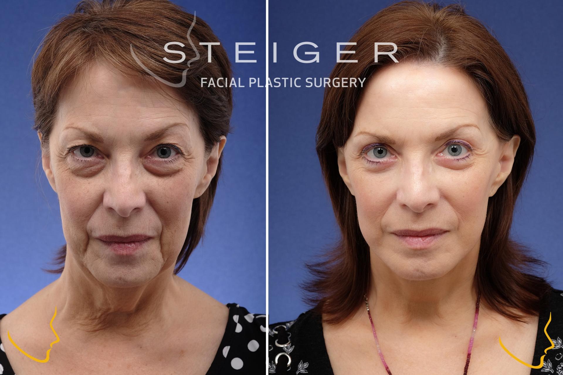Steiger Facial Plastic Surgery facelift result — Boca Raton, FL