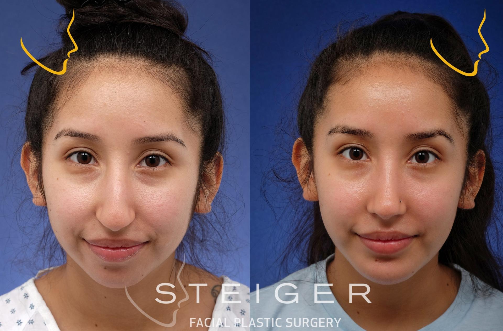 Steiger Facial Plastic Surgery rhinoplasty result — Boca Raton, FL