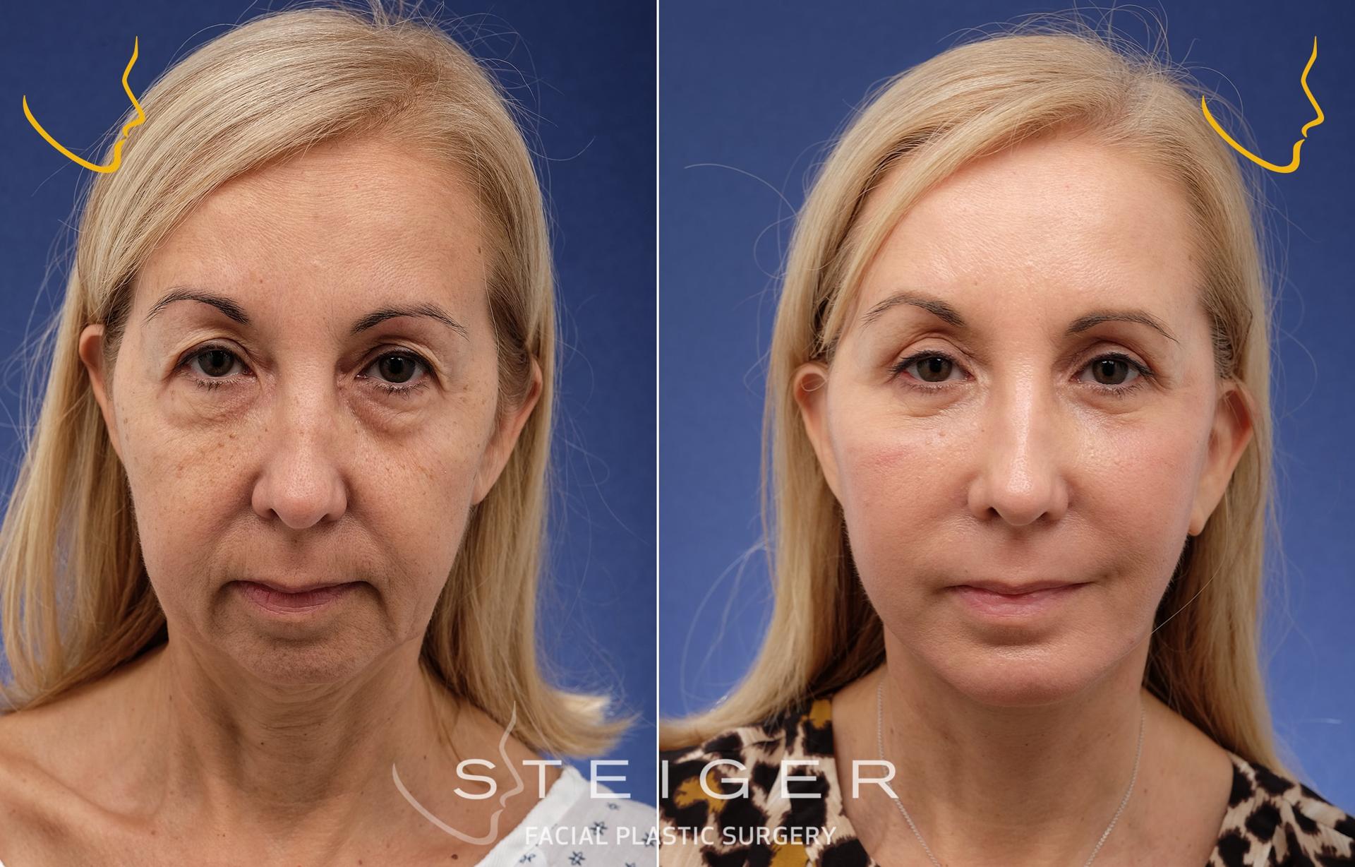 Steiger Facial Plastic Surgery facelift result — Boca Raton, FL