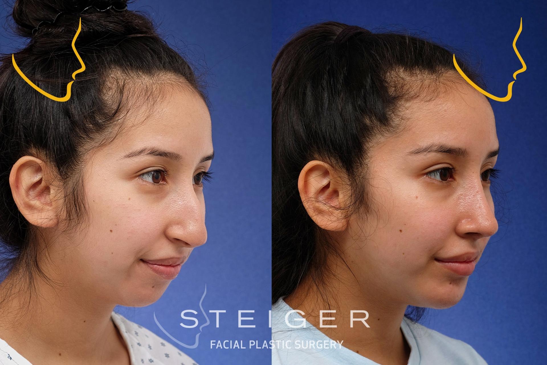 Steiger Facial Plastic Surgery rhinoplasty result — Boca Raton, FL