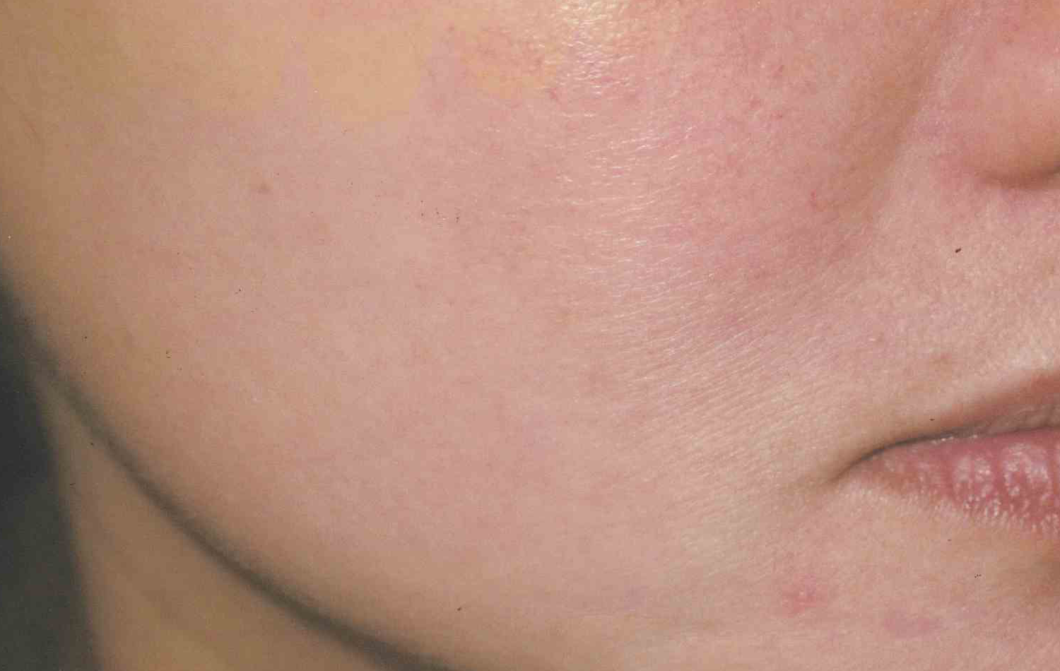 Medical Skin Aesthetics after — San Francisco, CA