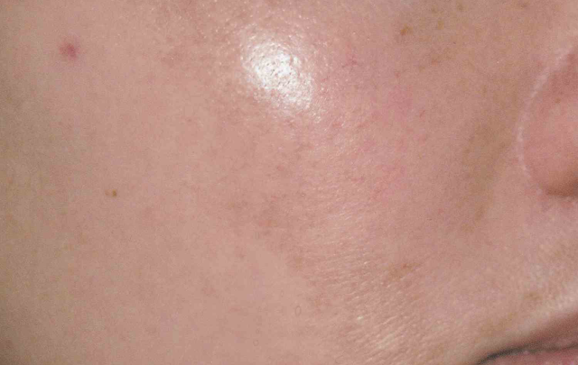 Laser Skin Resurfacing before at Medical Skin Aesthetics in San Francisco, CA