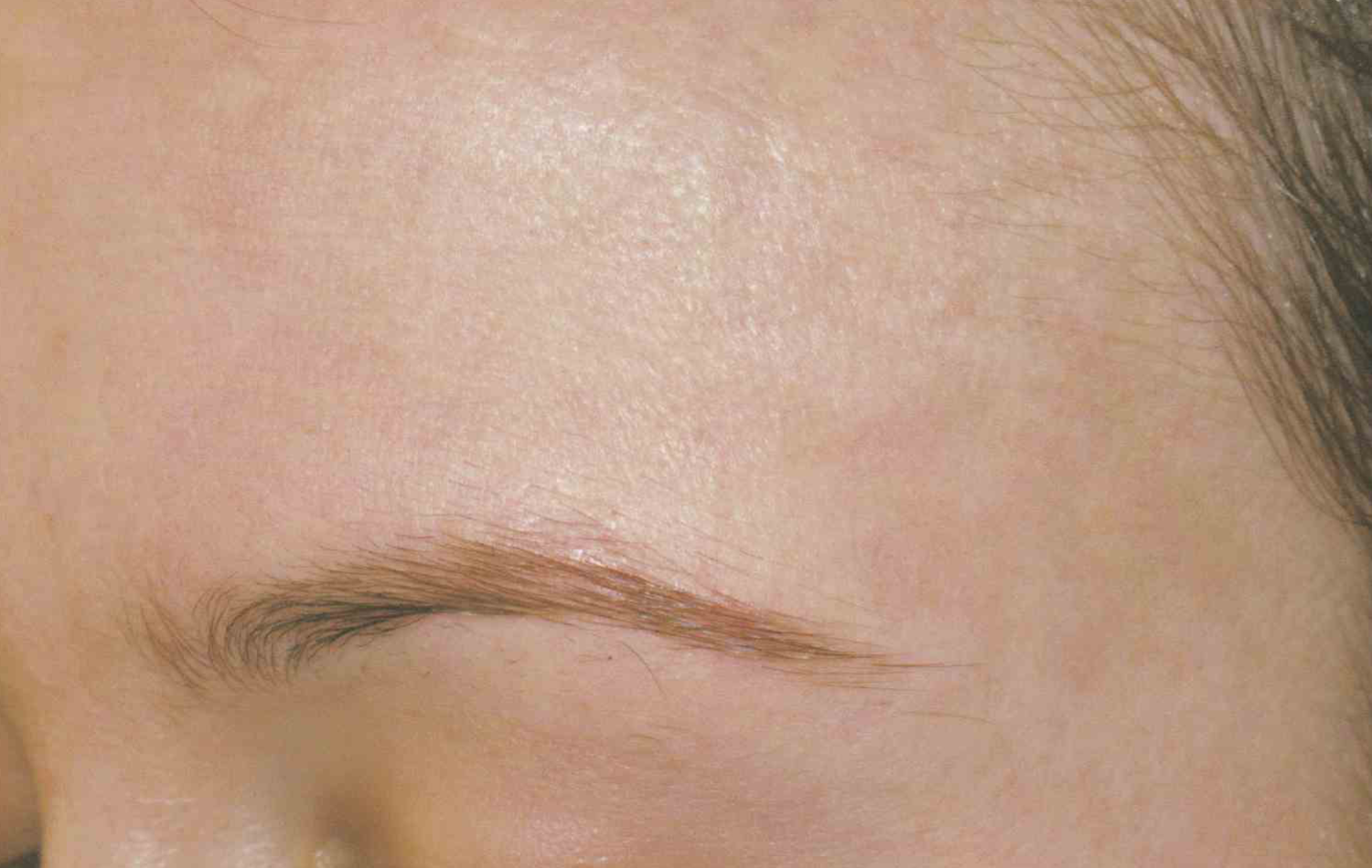 Medical Skin Aesthetics after — San Francisco, CA