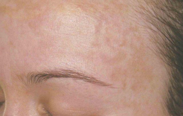 Laser Skin Resurfacing before at Medical Skin Aesthetics in San Francisco, CA