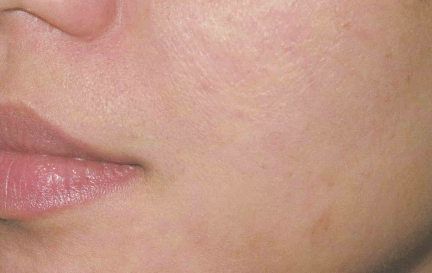 Medical Skin Aesthetics after — San Francisco, CA