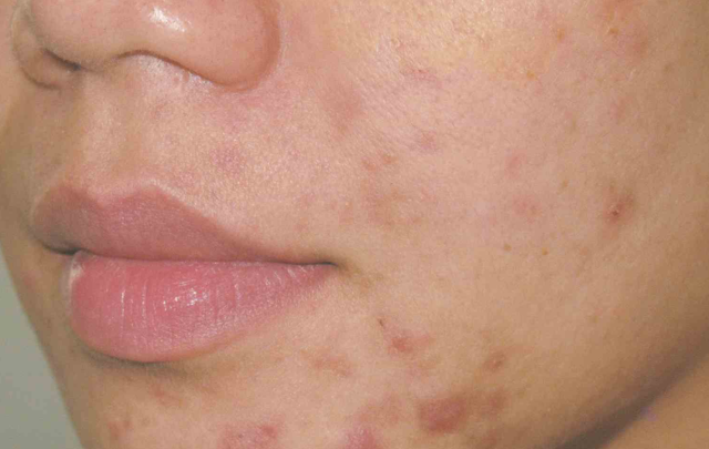 Laser Skin Resurfacing before at Medical Skin Aesthetics in San Francisco, CA