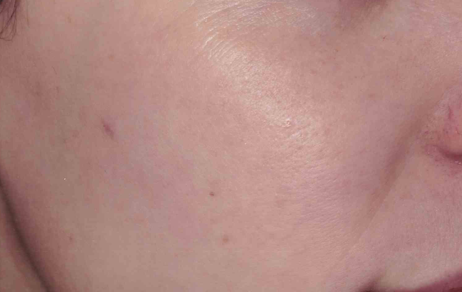 Medical Skin Aesthetics after — San Francisco, CA