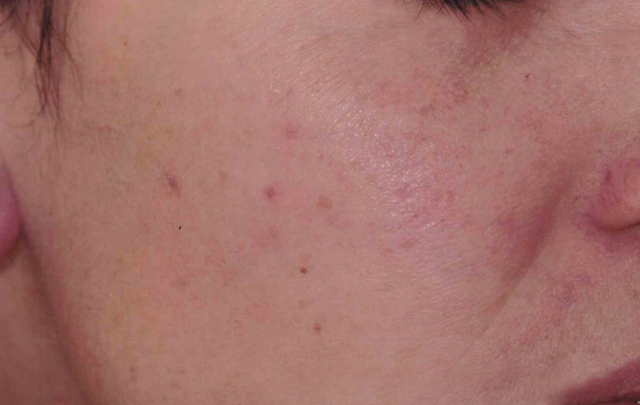 Laser Skin Resurfacing before at Medical Skin Aesthetics in San Francisco, CA
