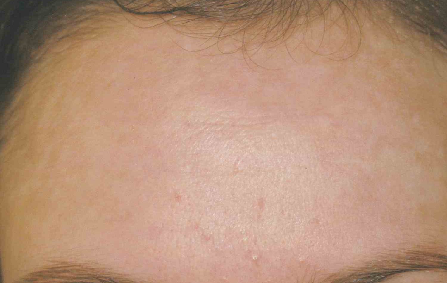 Medical Skin Aesthetics after — San Francisco, CA