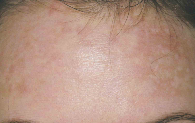Laser Skin Resurfacing before at Medical Skin Aesthetics in San Francisco, CA