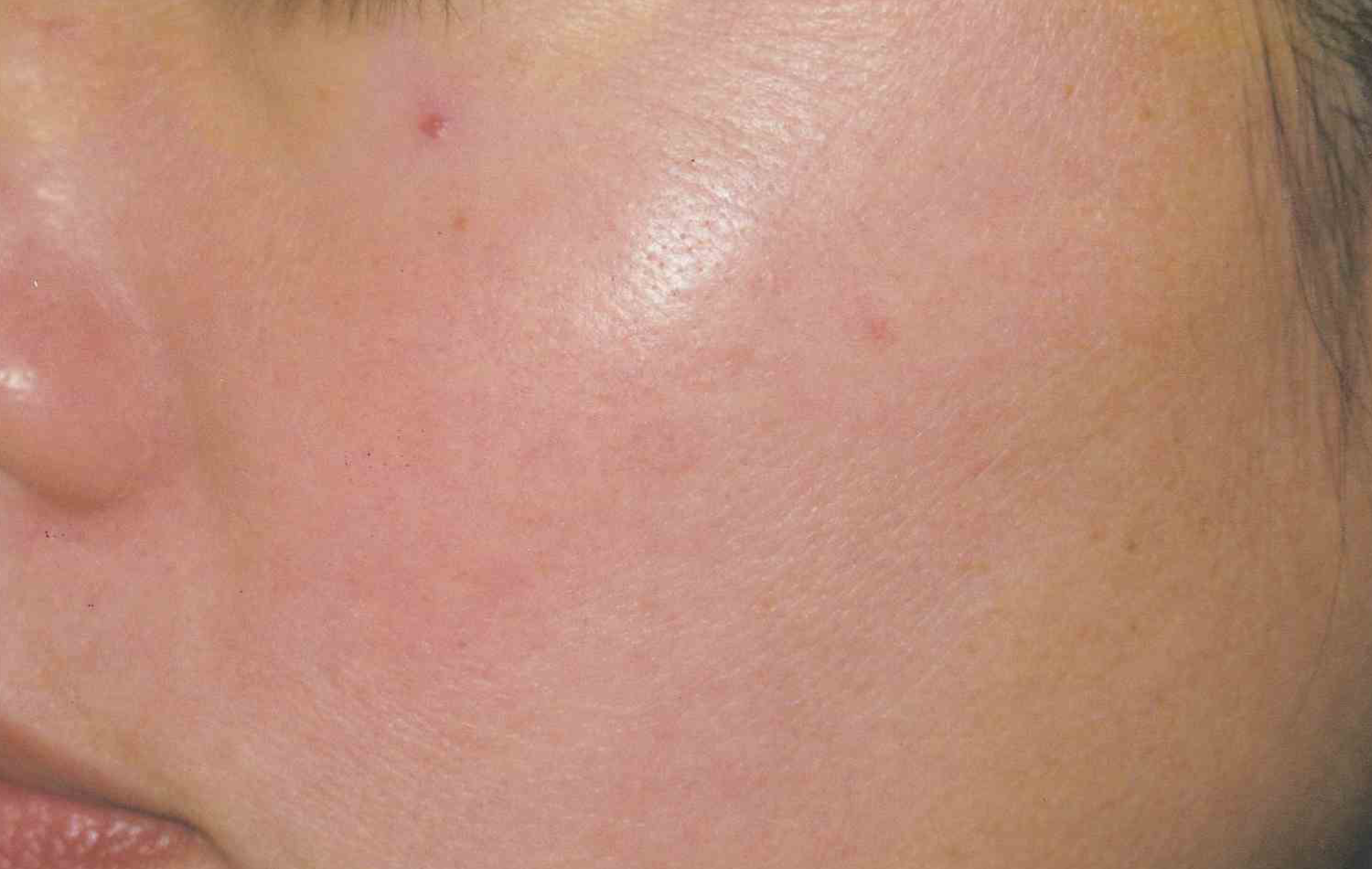 Medical Skin Aesthetics after — San Francisco, CA