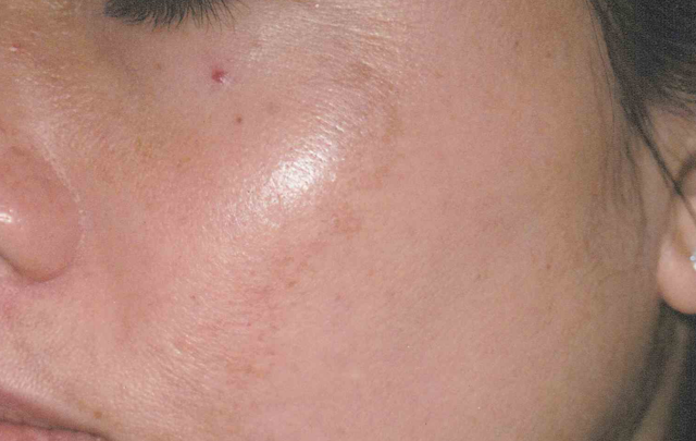 Laser Skin Resurfacing before at Medical Skin Aesthetics in San Francisco, CA