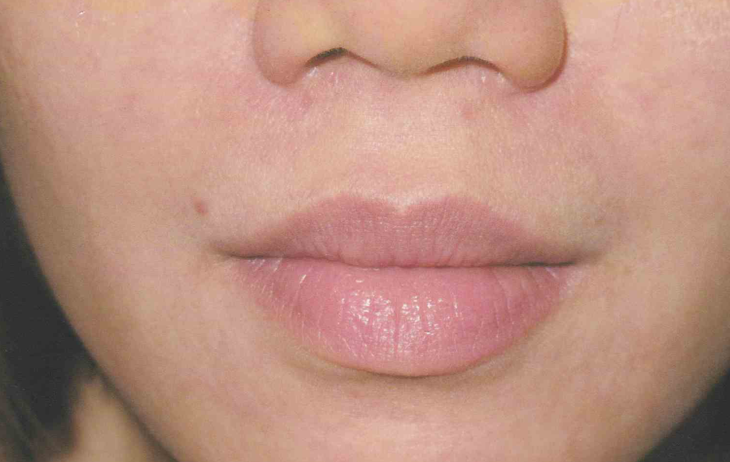Medical Skin Aesthetics after — San Francisco, CA