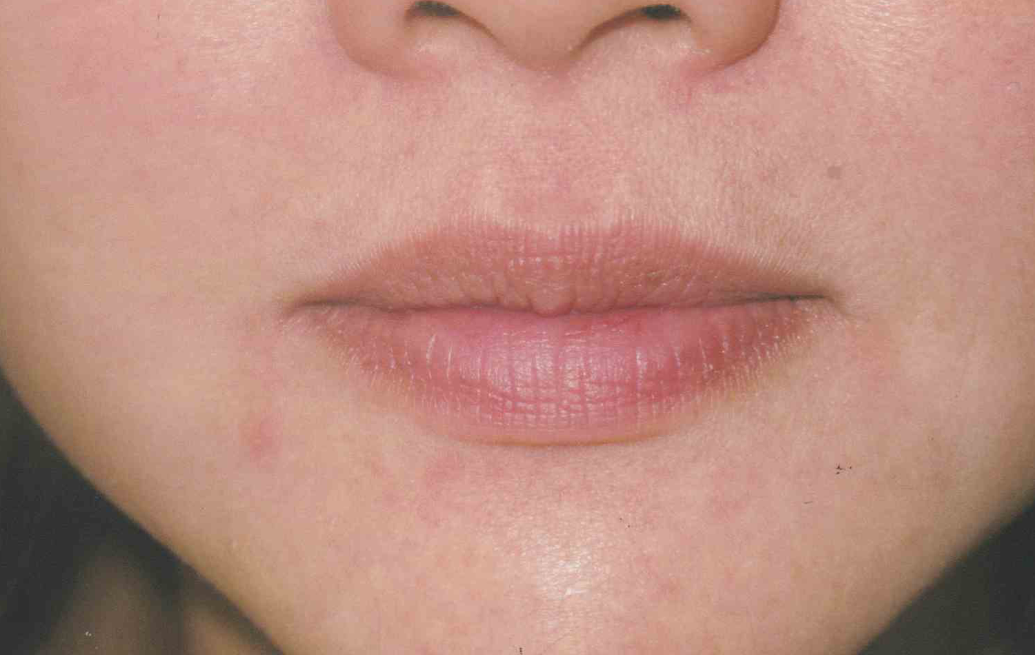 Medical Skin Aesthetics after — San Francisco, CA