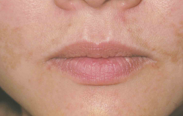 Laser Skin Resurfacing before at Medical Skin Aesthetics in San Francisco, CA