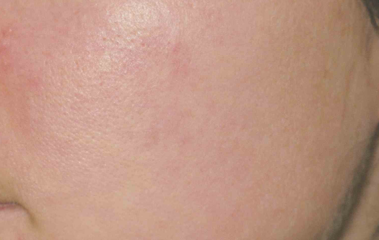 Medical Skin Aesthetics after — San Francisco, CA