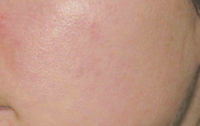 Laser Skin Resurfacing after at Medical Skin Aesthetics in San Francisco, CA