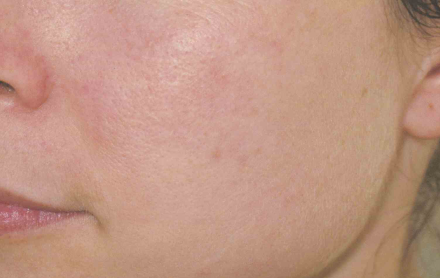 Laser Skin Resurfacing before at Medical Skin Aesthetics in San Francisco, CA