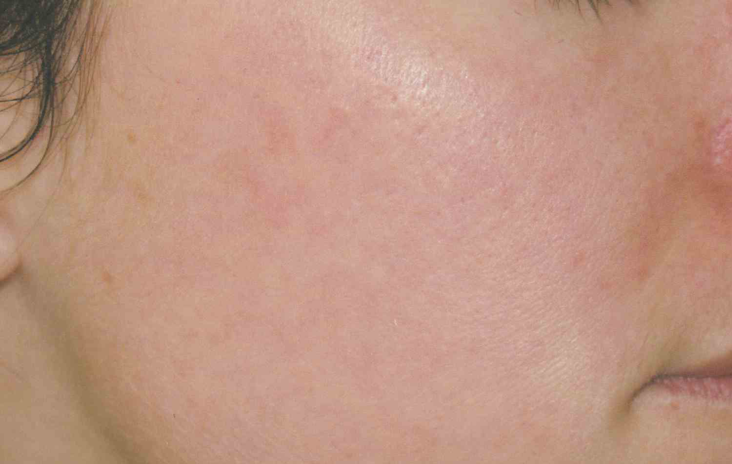 Medical Skin Aesthetics after — San Francisco, CA