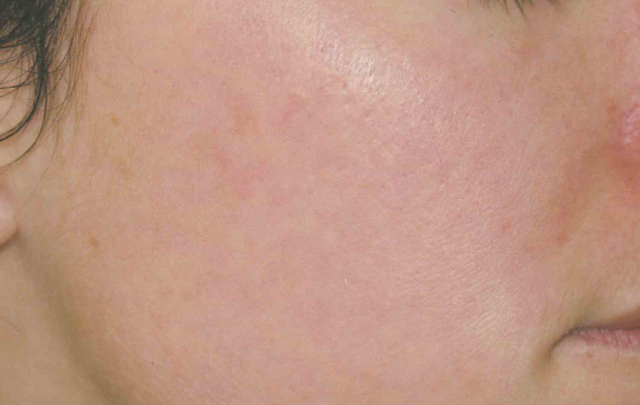 Laser Skin Resurfacing after at Medical Skin Aesthetics in San Francisco, CA