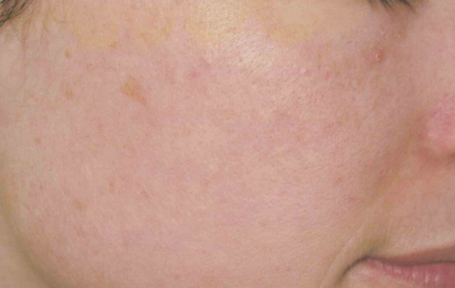 Laser Skin Resurfacing before at Medical Skin Aesthetics in San Francisco, CA