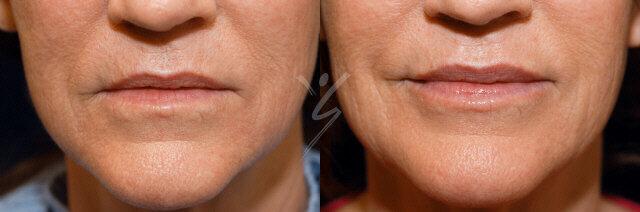 About Faces Cosmetic Surgery and Med Spa result — Tucson, AZ