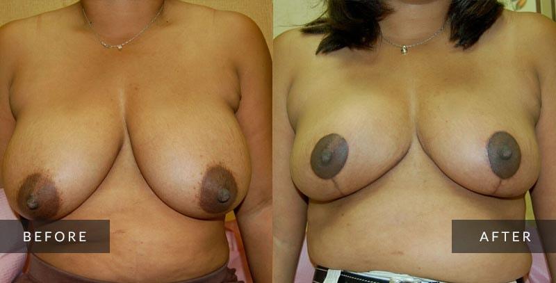 Sean A. Wright, MD breast reduction result — Media, PA