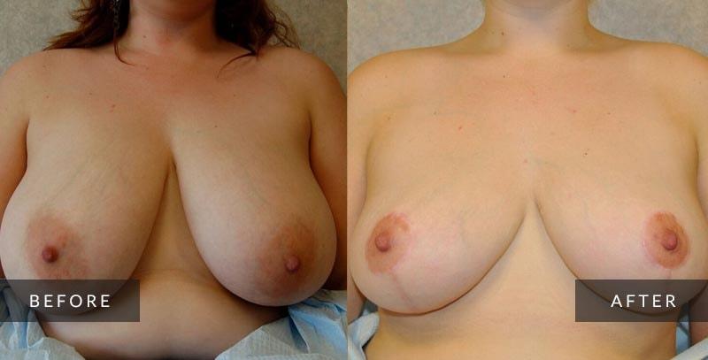 Sean A. Wright, MD breast reduction result — Media, PA