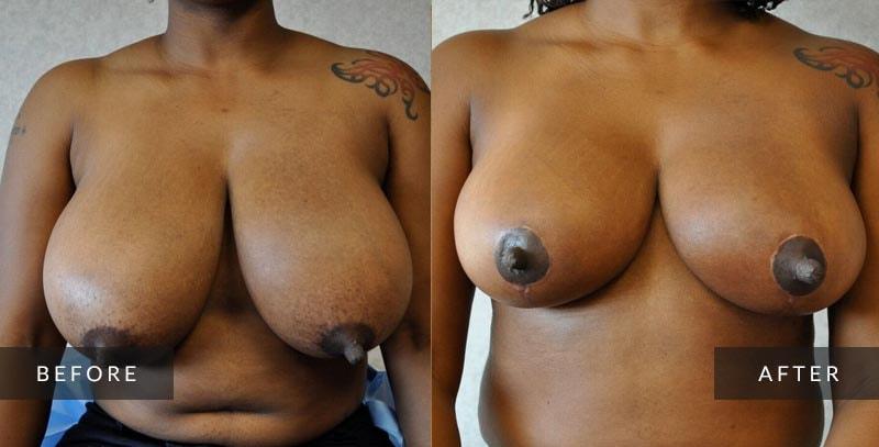Sean A. Wright, MD breast reduction result — Media, PA
