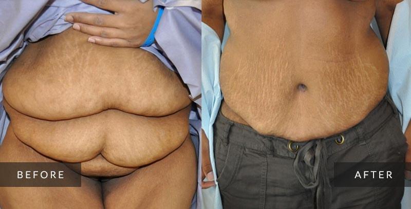 Sean A. Wright, MD tummy tuck result — Media, PA