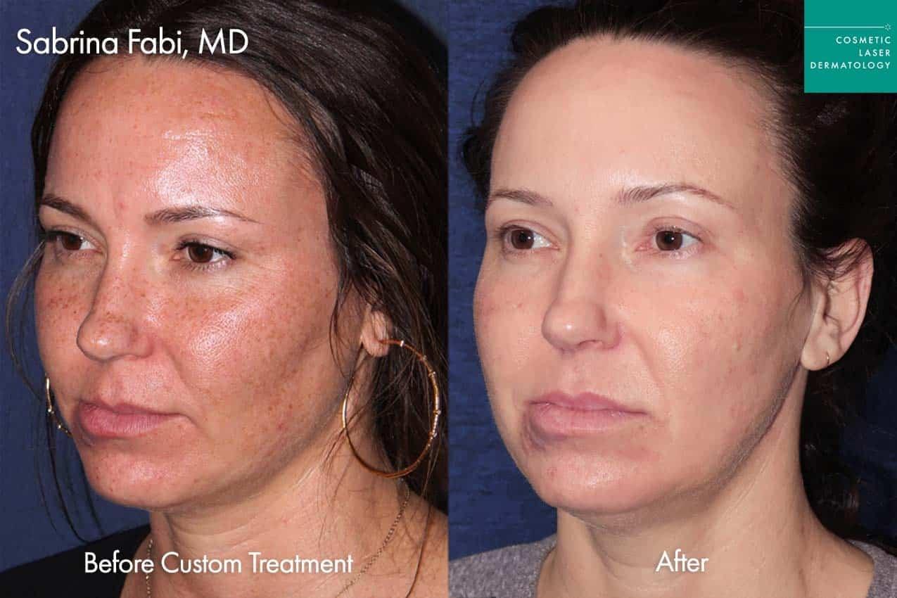 Cosmetic Laser Dermatology laser treatment result — San Diego, CA