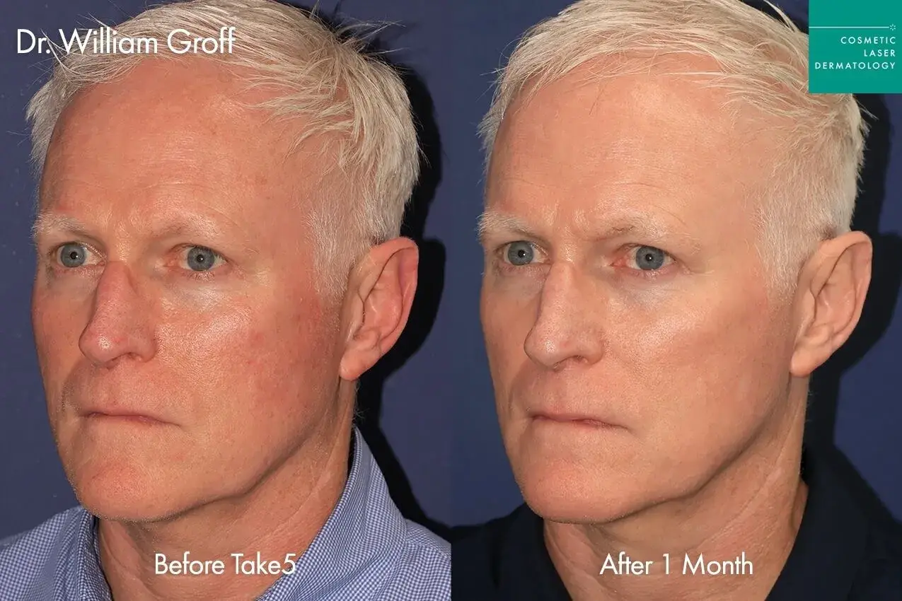 Cosmetic Laser Dermatology laser treatment result — San Diego, CA
