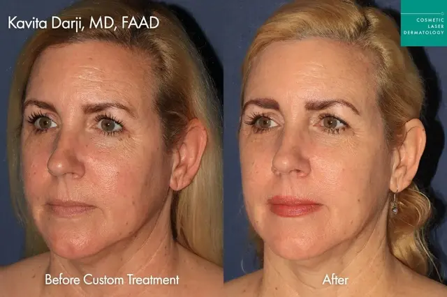 Laser Skin Resurfacing result at Cosmetic Laser Dermatology in San Diego, CA