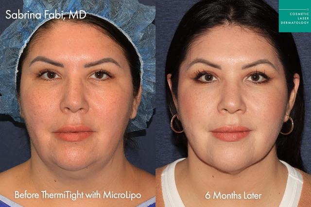 Neck Liposuction result at Cosmetic Laser Dermatology in San Diego, CA