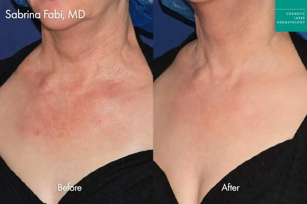 Cosmetic Laser Dermatology laser treatment result — San Diego, CA