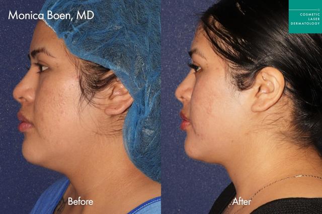 Neck Liposuction result at Cosmetic Laser Dermatology in San Diego, CA