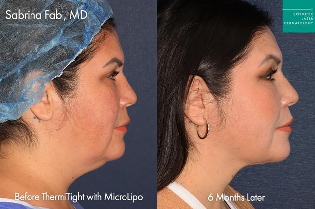 Neck Liposuction result at Cosmetic Laser Dermatology in San Diego, CA