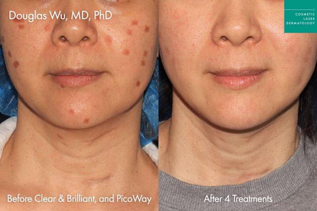 Laser Skin Resurfacing result at Cosmetic Laser Dermatology in San Diego, CA