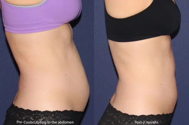 Thigh Lift result at Cosmetic Laser Dermatology in San Diego, CA