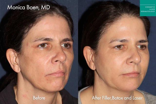 Dermal Fillers result at Cosmetic Laser Dermatology in San Diego, CA